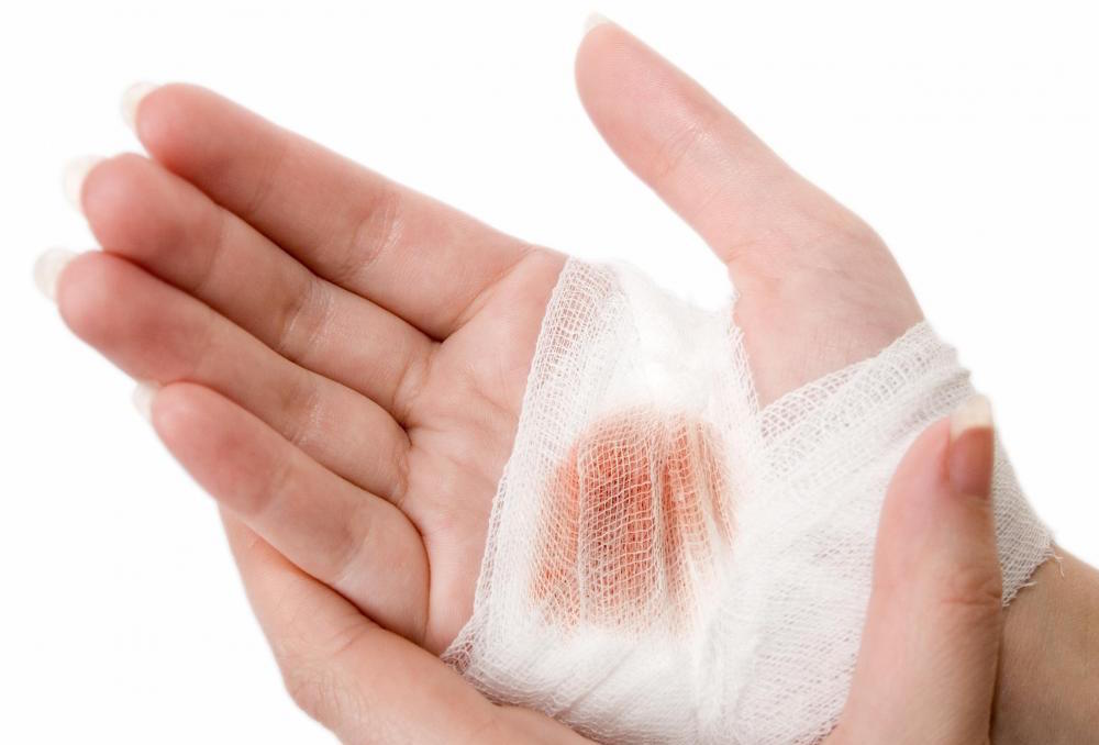 Nanostructured dressings accelerate burn wound healing: Researchers claim