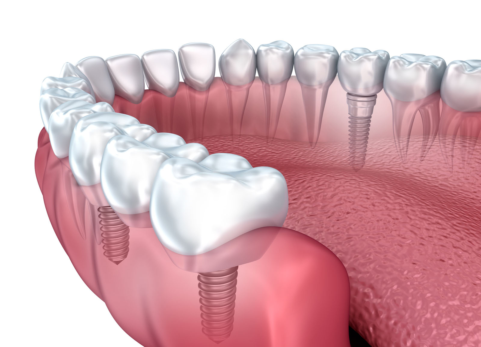 Significant Improvement of Dental Implants through Ultrasonic Modifications